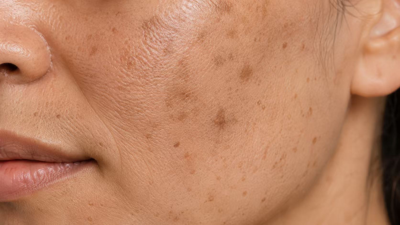 Skin with visible post-blemish marks